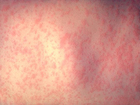 Person with measles traveled through Kern County