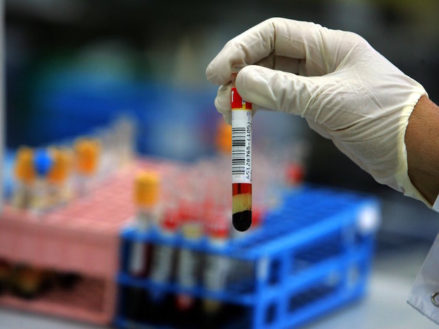 First case of super-resistant gonorrhea reported in the UK