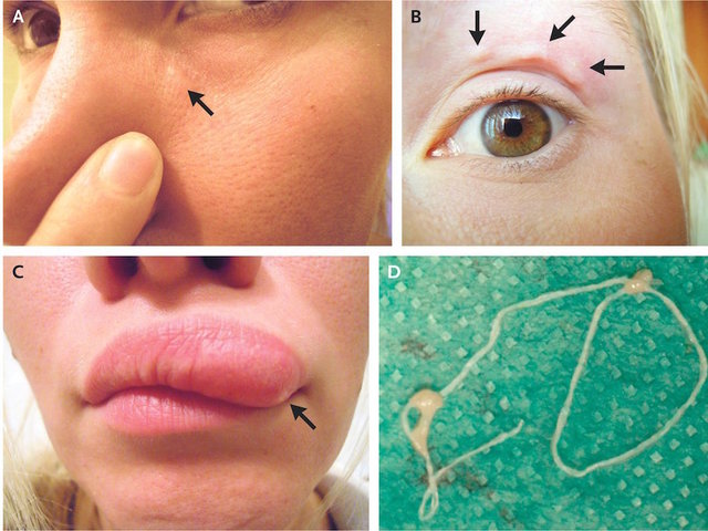 Woman's selfies capture moving lump on face: a parasite