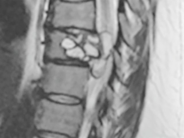 A woman went to a hospital in France for tingling legs. It turned out to be parasite in her back