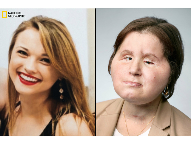 Historic face transplant gives suicide survivor a 'second chance'