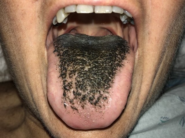 Black hairy tongue: What to know about the bizarre disease