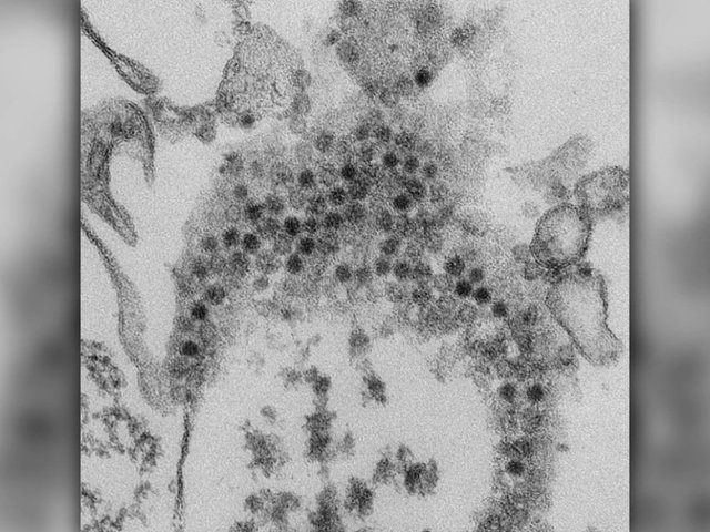 More US children confirmed with paralyzing polio-like illness AFM